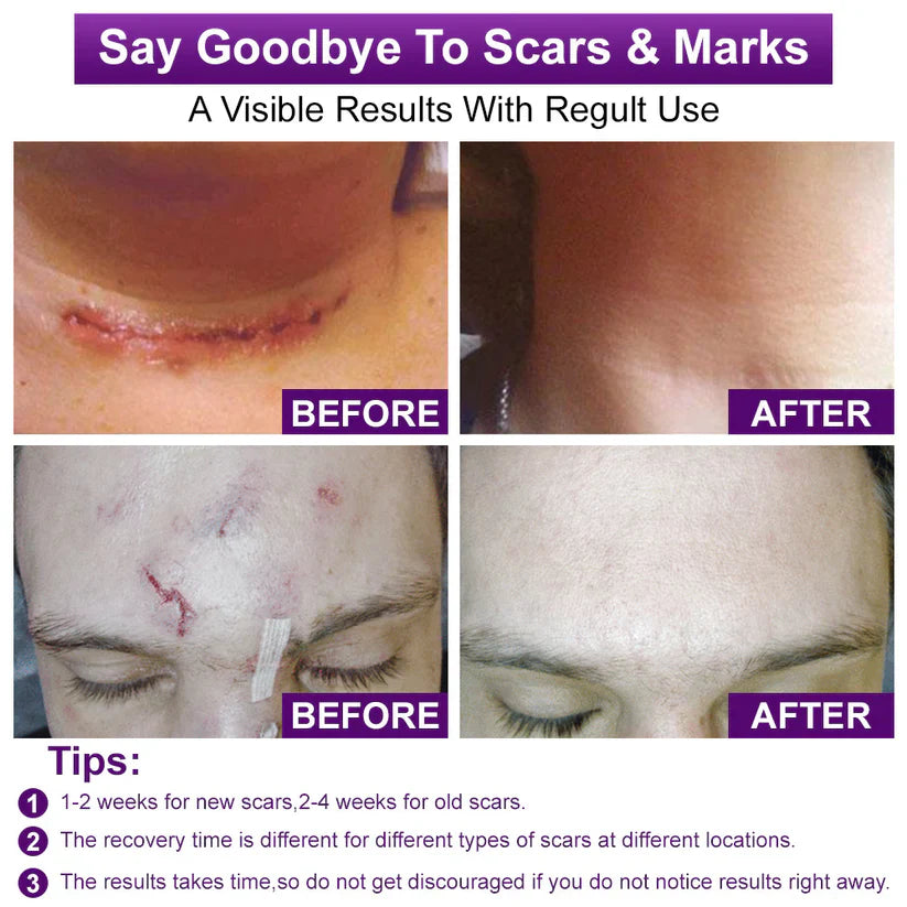 💙 UKCA-Certified ✅Misspone® Scar Gel – Clinically Proven to Fade Surgical, Acne, Burn & Trauma Scars