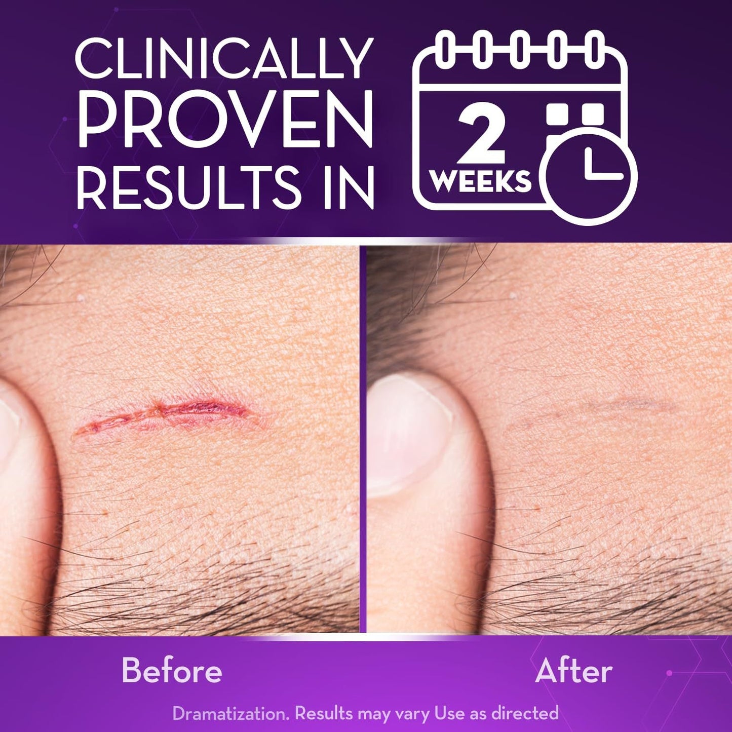 💙 UKCA-Certified ✅Misspone® Scar Gel – Clinically Proven to Fade Surgical, Acne, Burn & Trauma Scars